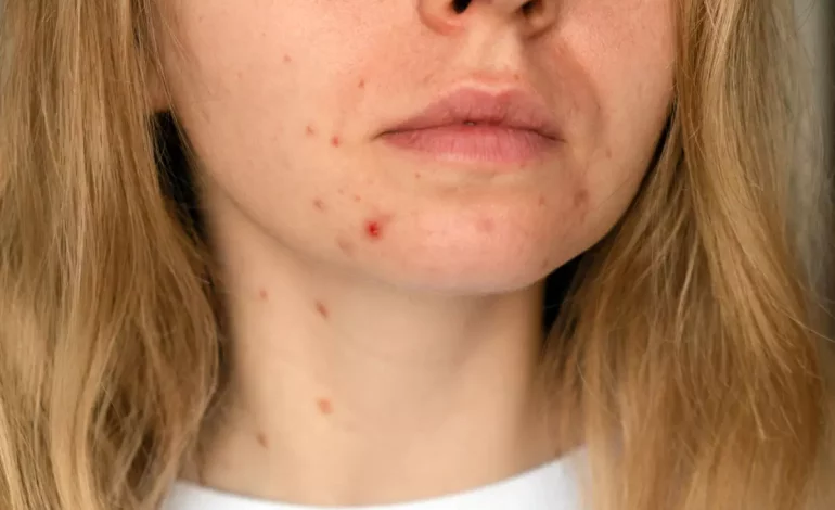 Lutte contre l'acné après 30 ans : les solutions pour en finir avec l'acné de l'adulte