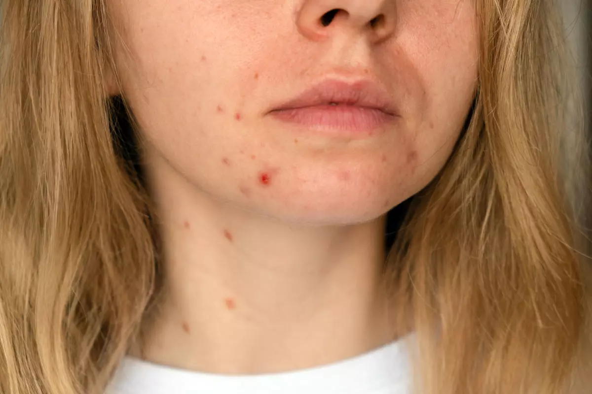Lutte contre l'acné après 30 ans : les solutions pour en finir avec l'acné de l'adulte